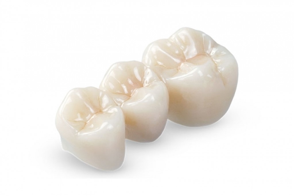 ceramic Crowns