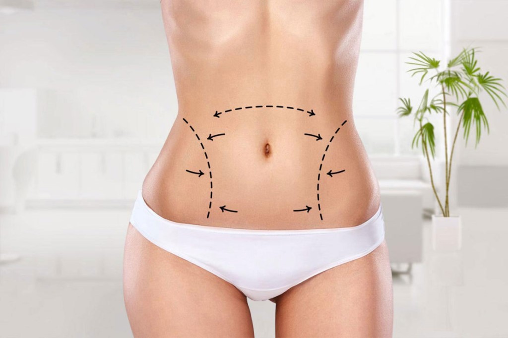 liposuction